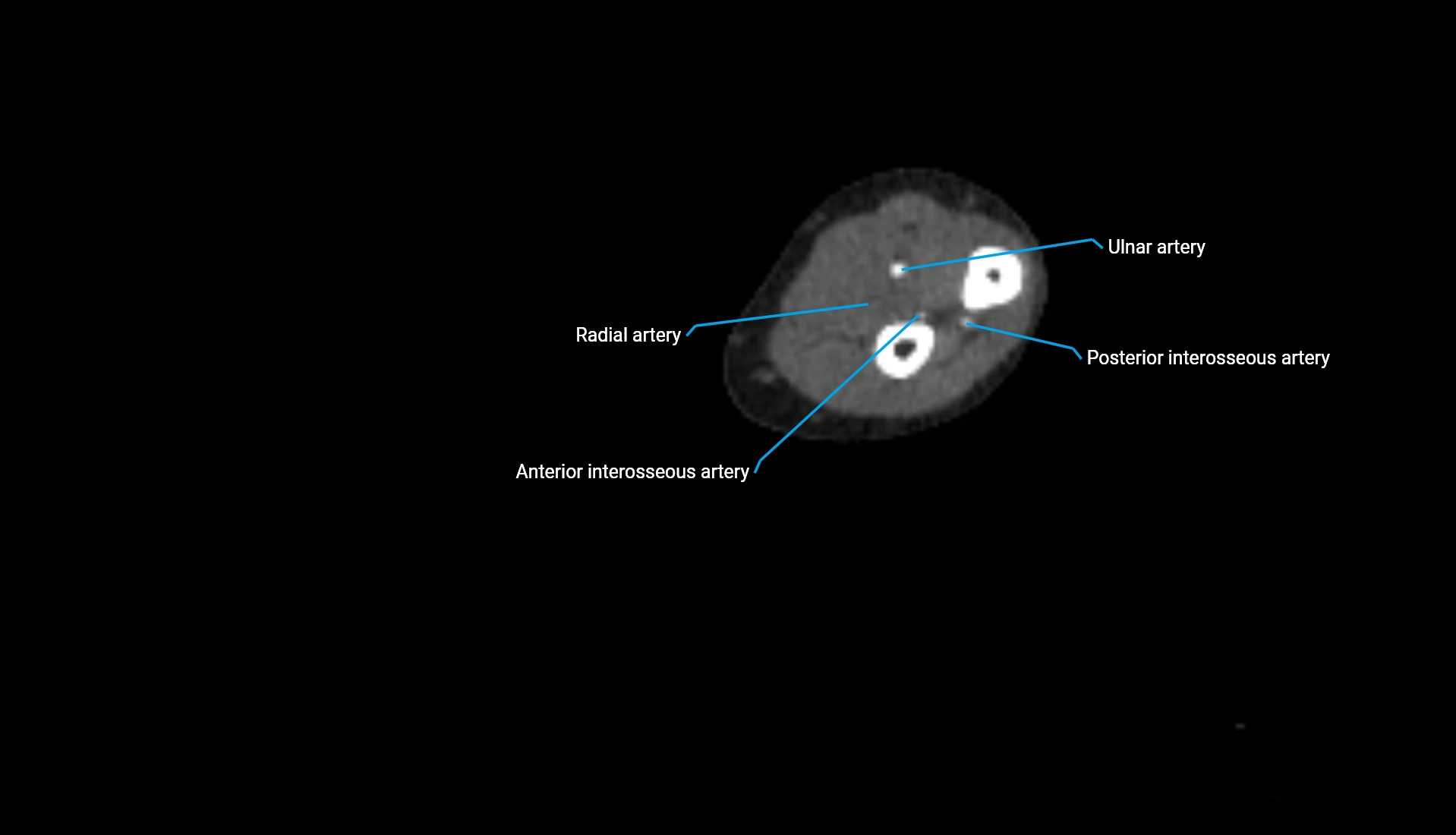 CTA upper limb axial cross sectional anatomy labelled image 156 (2).webp